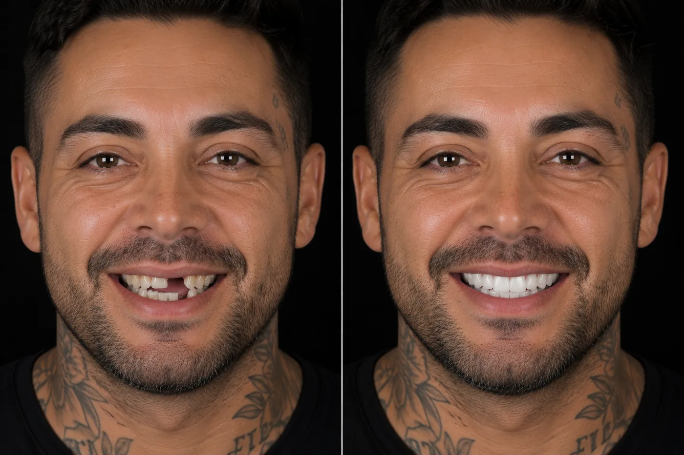 Before and after — 3 Dental Implants — ID Wellness Dental Newark NJ