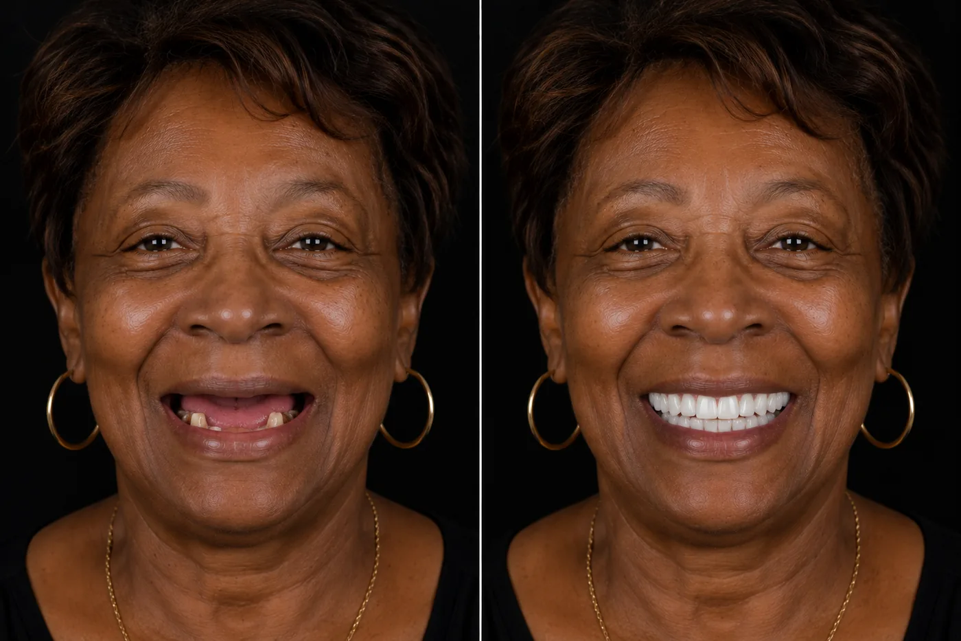 Before and after — All-on-4 Lower Arch — ID Wellness Dental Newark NJ