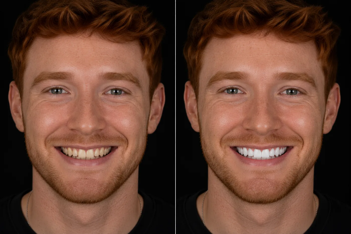Before and after — Composite Bonding & Whitening — ID Wellness Dental Newark NJ