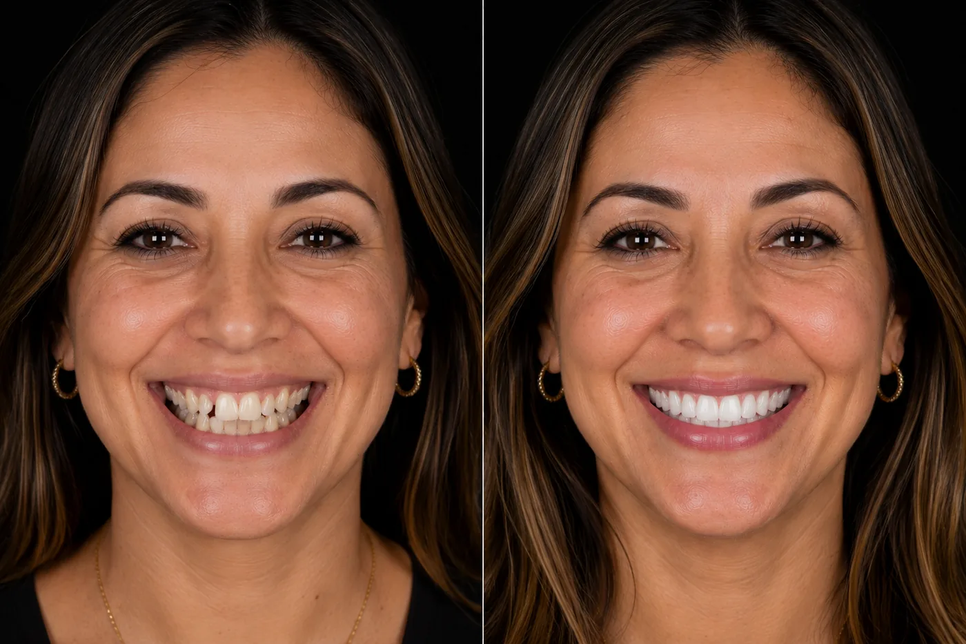 Before and after — Invisalign — 14 Months — ID Wellness Dental Newark NJ