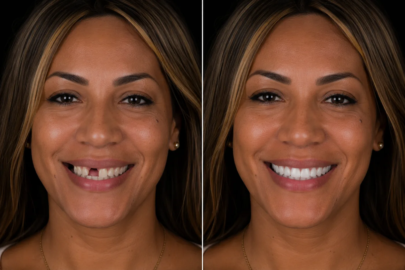Before and after — Single Implant with Crown — ID Wellness Dental Newark NJ