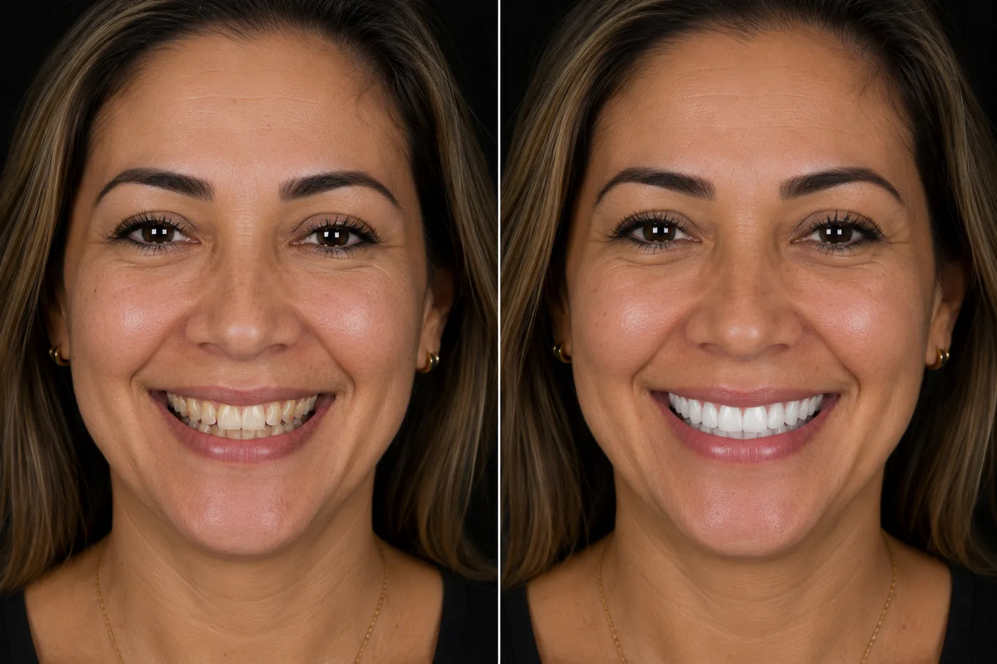 Before and after — Smile Makeover with Veneers — ID Wellness Dental Newark NJ